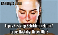 Lupus Hastalığı Belirtileri Nelerdir