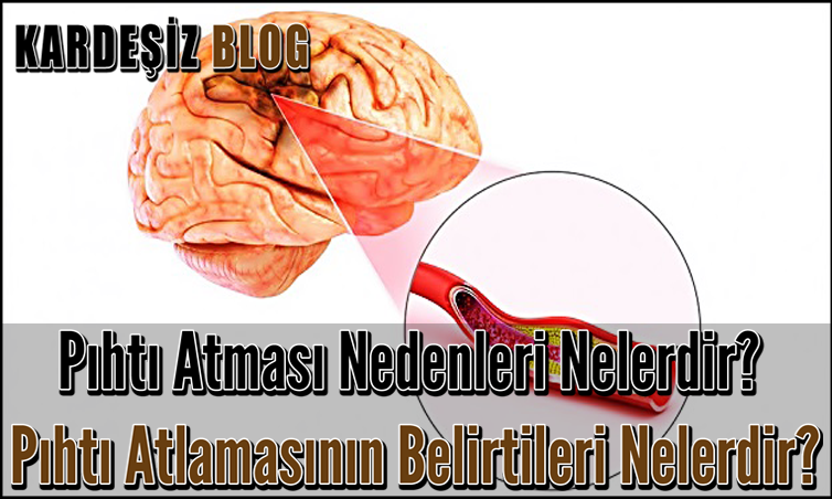 Pıhtı Atması Nedenleri Nelerdir