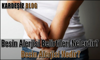 Besin Alerjisi Belirtileri Nelerdir