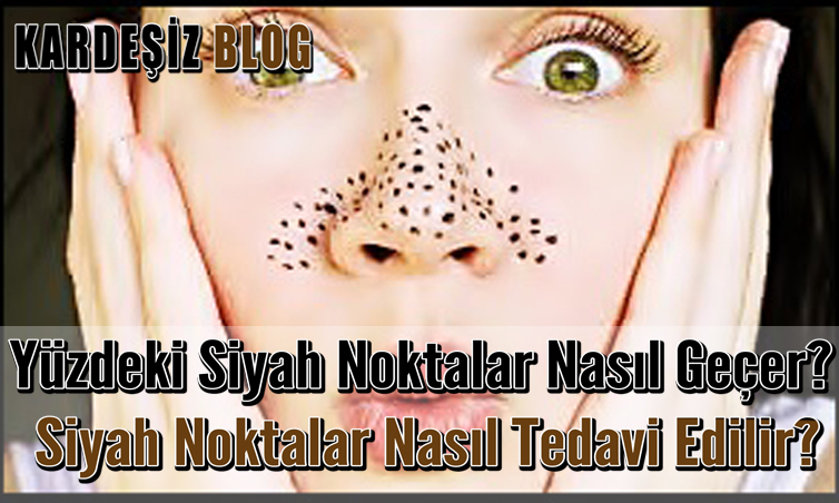 Yüzdeki Siyah Noktalar Nasıl Geçer