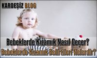 Bebeklerde Kızamık Nasıl Geçer