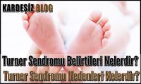 Turner Sendromu Belirtileri Nelerdir