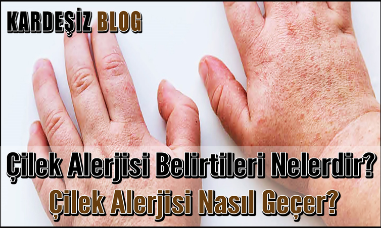 Çilek Alerjisi Belirtileri Nelerdir