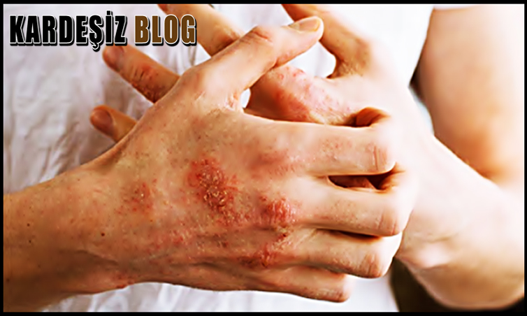 Deterjan Alerjisi Nedir