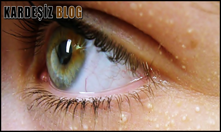 Göz Altı Yağ Bezeleri Tedavisi