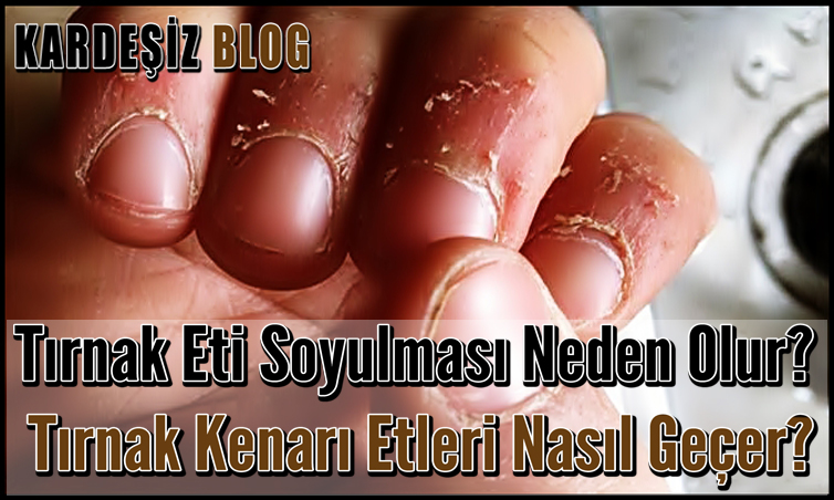 Tırnak Eti Soyulması Neden Olur
