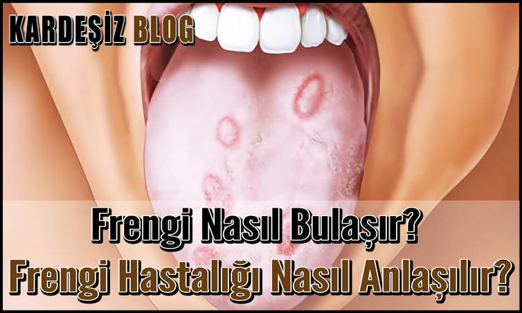Frengi Nasıl Bulaşır