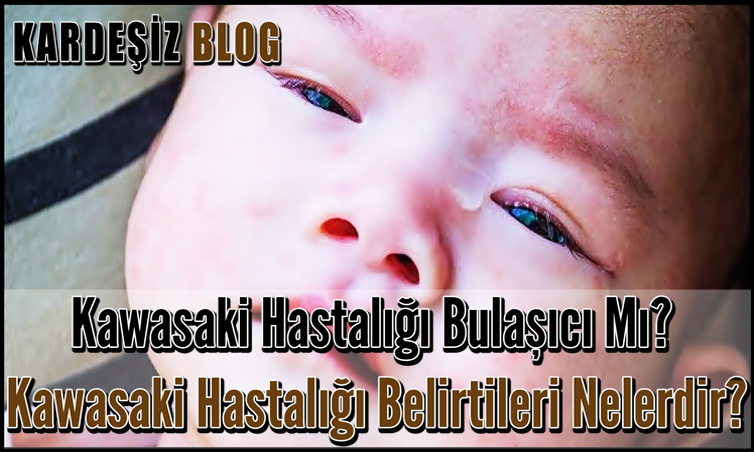 Kawasaki Hastalığı Bulaşıcı Mı