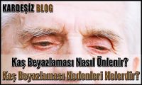 Kaş Beyazlaması Nasıl Önlenir