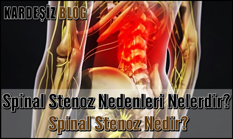 Spinal Stenoz Nedenleri Nelerdir