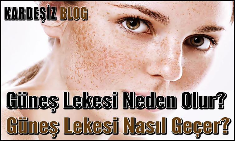 Güneş Lekesi Neden Olur