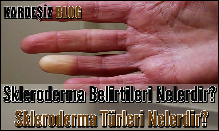 Skleroderma Belirtileri Nelerdir