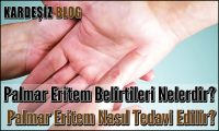 Palmar Eritem Belirtileri Nelerdir