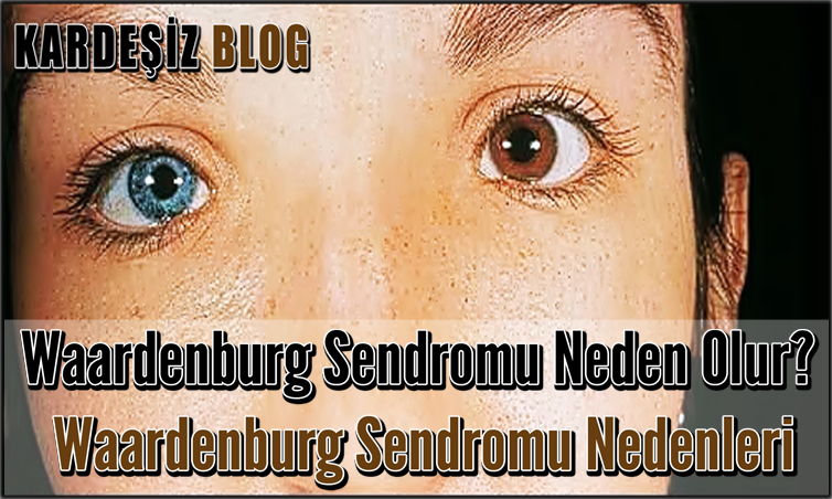 Waardenburg Sendromu Neden Olur