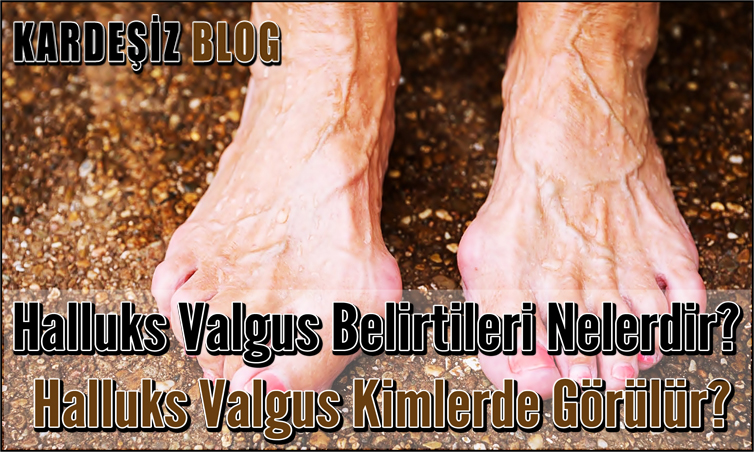 Halluks Valgus Belirtileri Nelerdir