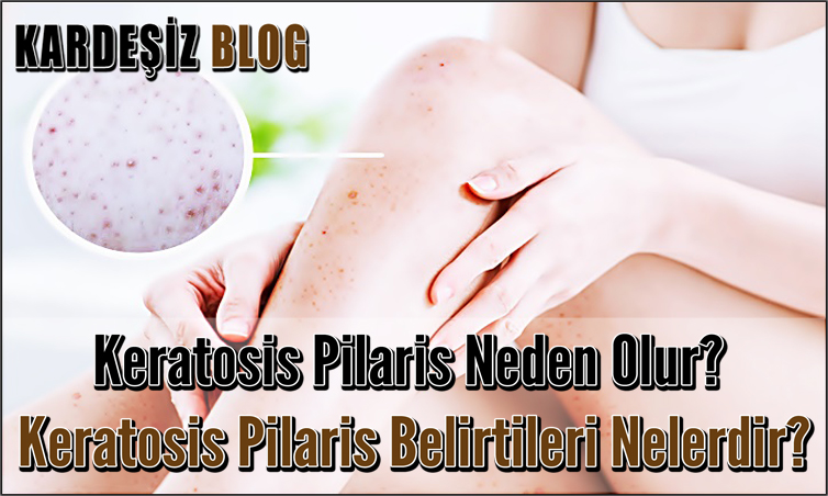 Keratosis Pilaris Neden Olur
