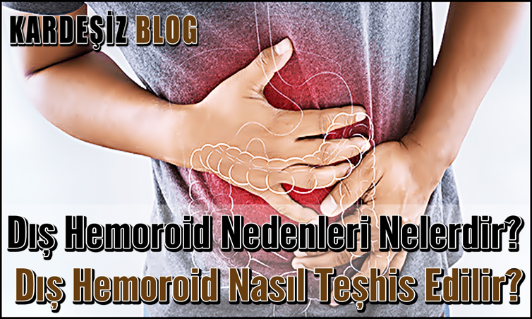 Dış Hemoroid Nedenleri Nelerdir