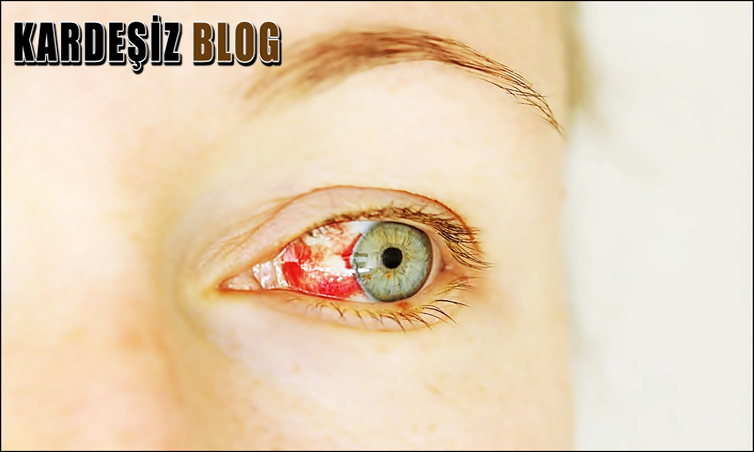 Göz Kanlanması Nasıl Geçer