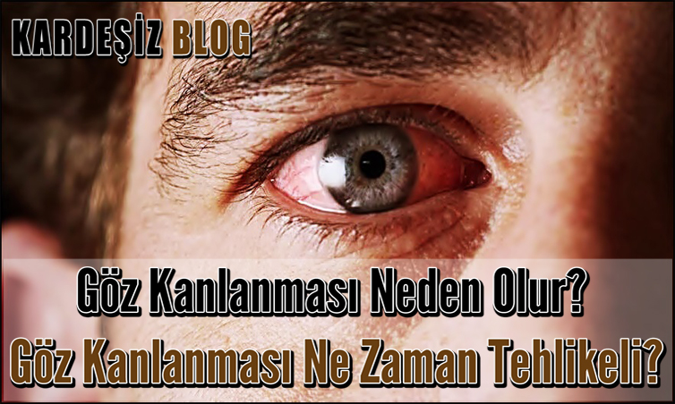Göz Kanlanması Neden Olur