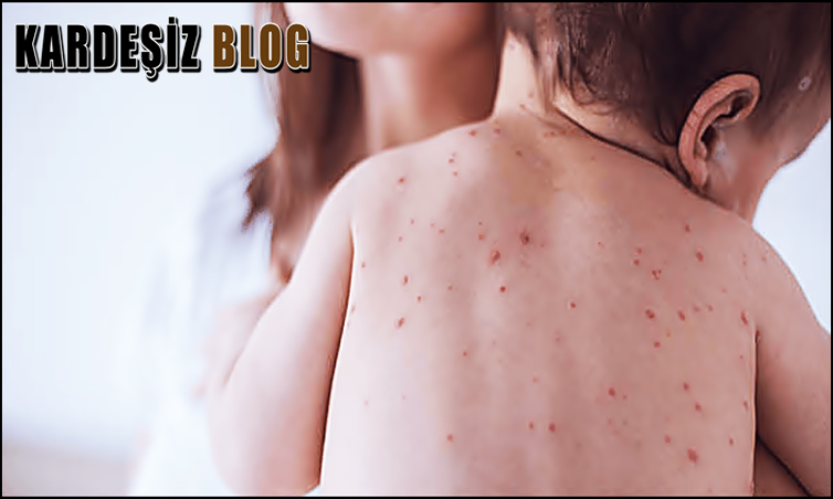Kızıl Hastalığı Bulaşıcı Mı