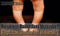 Raşitizm Belirtileri Nelerdir