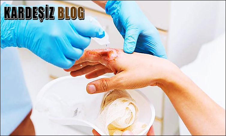 Çamaşır Suyu Yanığna Hangi Krem İyi Gelir