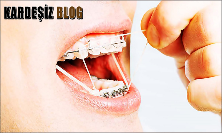Diş Teli Tedavisi Kaç Ayda Düzelir