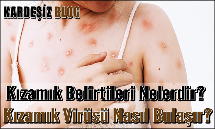 Kızamık Belirtileri Nelerdir