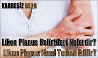 Liken Planus Belirtileri Nelerdir
