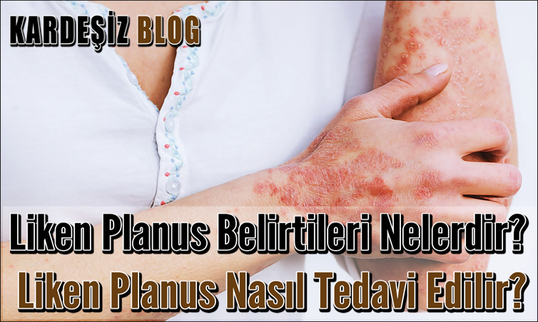 Liken Planus Belirtileri Nelerdir