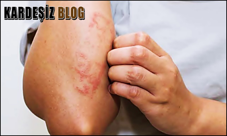 Liken Planus Tehlikeli Mi