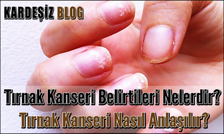 Tırnak Kanseri Belirtileri Nelerdir