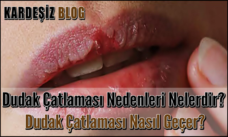 Dudak Çatlaması Nedenleri Nelerdir
