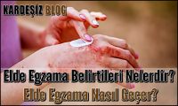 Elde Egzama Belirtileri Nelerdir