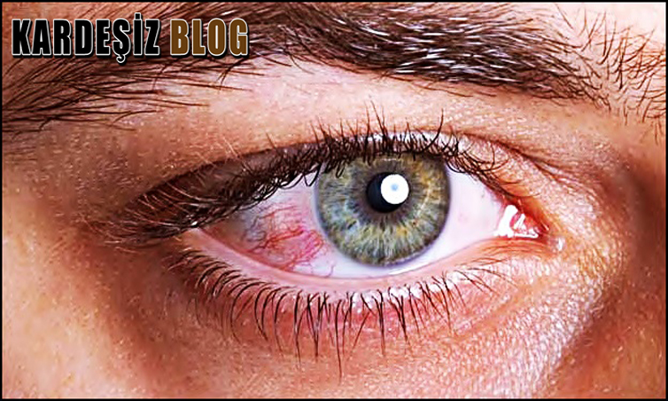 Göz Kanaması Göze Zarar Verir Mi