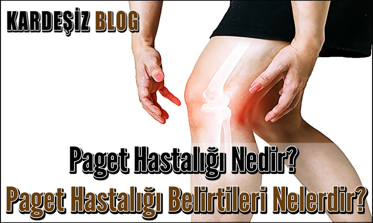 Paget Hastalığı Nedir