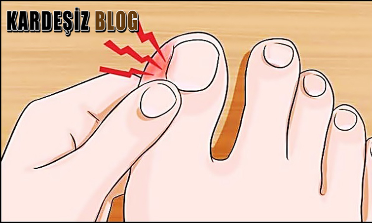 Tırnak iltihabı Kaç Günde Geçer