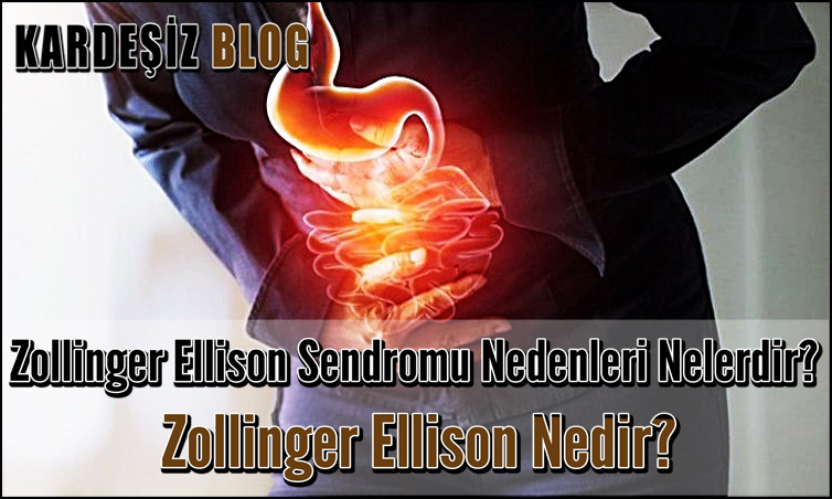 Zollinger Ellison Sendromu Nedenleri Nelerdir