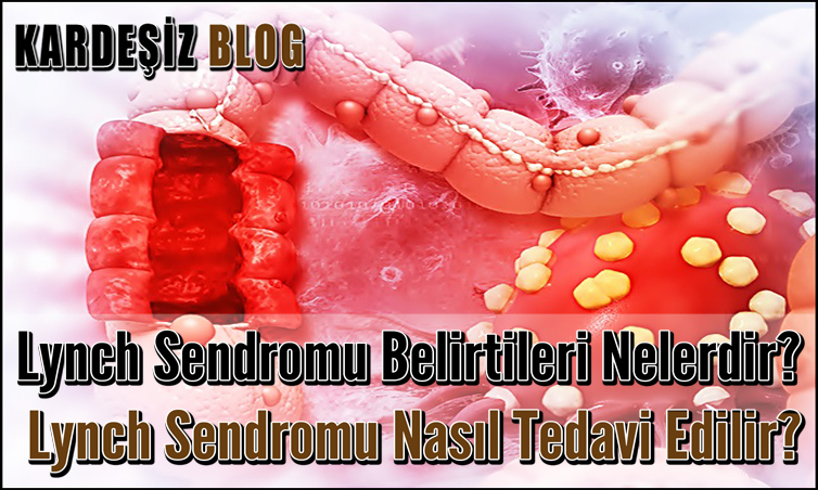 Lynch Sendromu Belirtileri Nelerdir
