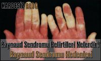 Raynaud Sendromu Belirtileri Nelerdir