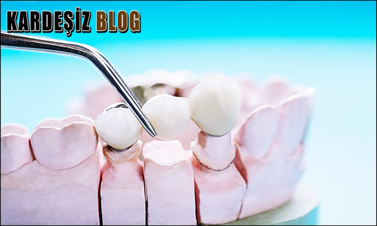 Klasik Köprü Diş Temizliği Nasıl Yapılır