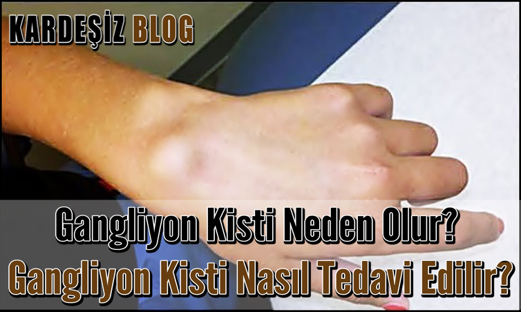 Gangliyon Kisti Neden Olur