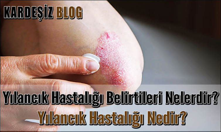 Yılancık Hastalığı Belirtileri Nelerdir