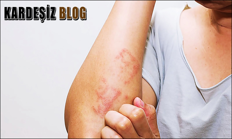 Yılancık Hastalığı Nasıl Geçer