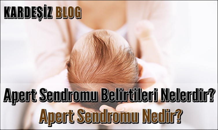 Apert Sendromu Belirtileri Nelerdir