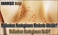 Molluskum Kontagiozum Kimlerde Görülür