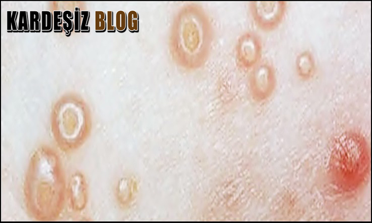 Molluskum Kontagiozum Tehlikeli Mi