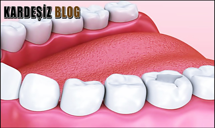 Geçici Dolgu Çıkarılırken Acır Mı