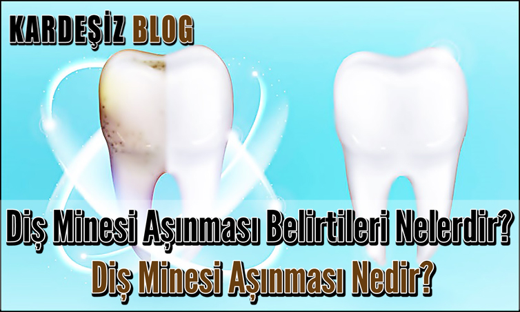 Diş Minesi Aşınması Belirtileri Nelerdir