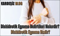Dishidrotik Egzama Belirtileri Nelerdir